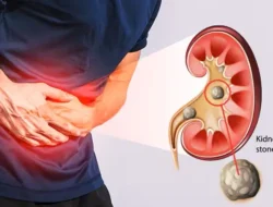 Minum Air Putih Cegah Batu Ginjal? Dokter Urologi: Tidak Sesederhana Itu