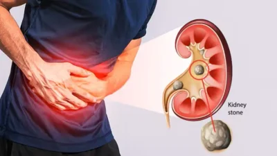 Minum Air Putih Cegah Batu Ginjal? Dokter Urologi: Tidak Sesederhana Itu