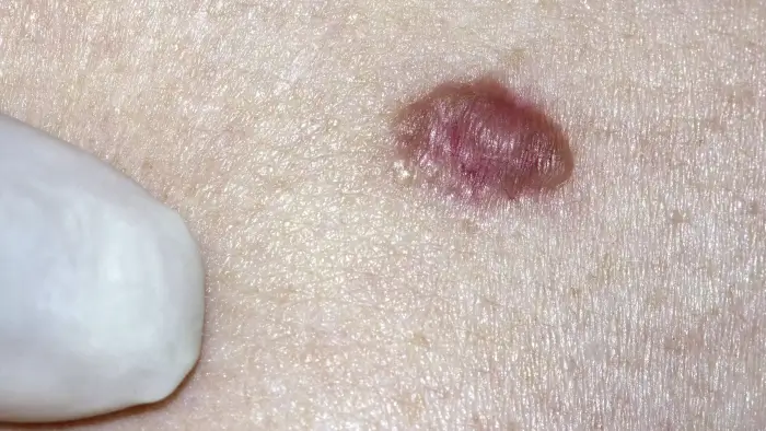 Waspadai Ciri-Ciri Kanker Kulit: Dari BCC, SCC, hingga Melanoma (Panduan Lengkap)