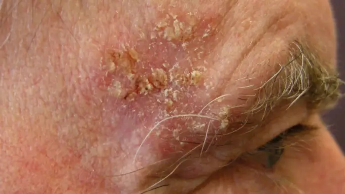 Waspadai Ciri-Ciri Kanker Kulit: Dari BCC, SCC, hingga Melanoma (Panduan Lengkap)