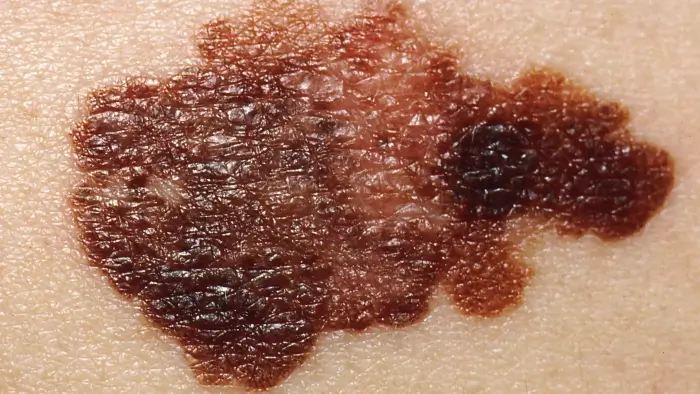 Waspadai Ciri-Ciri Kanker Kulit: Dari BCC, SCC, hingga Melanoma (Panduan Lengkap)